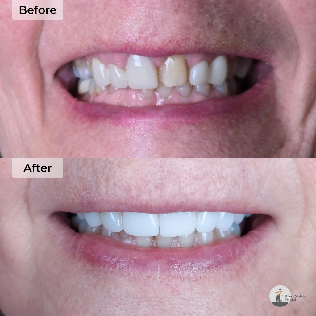 Veneers before and after in Chester Springs, PA at Byers Station Dental