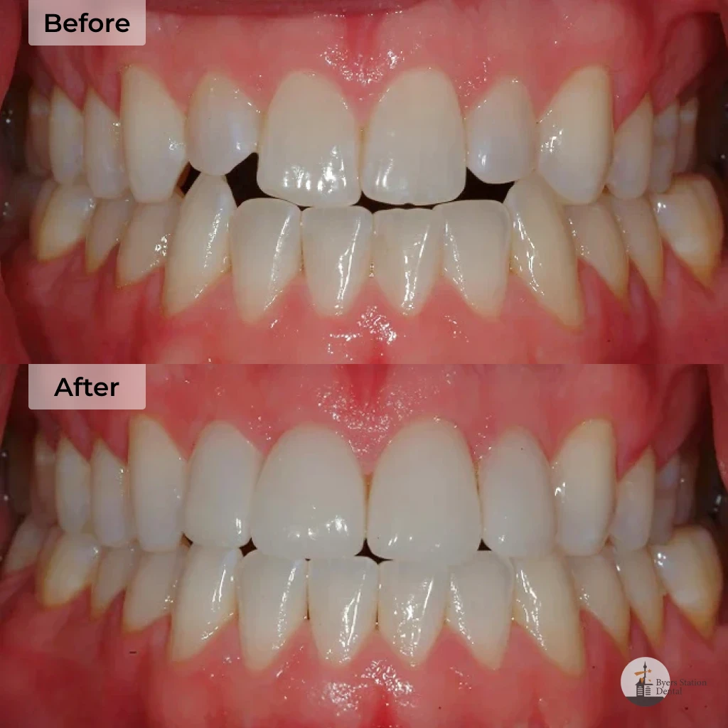 Veneers before and after in Chester Springs, PA