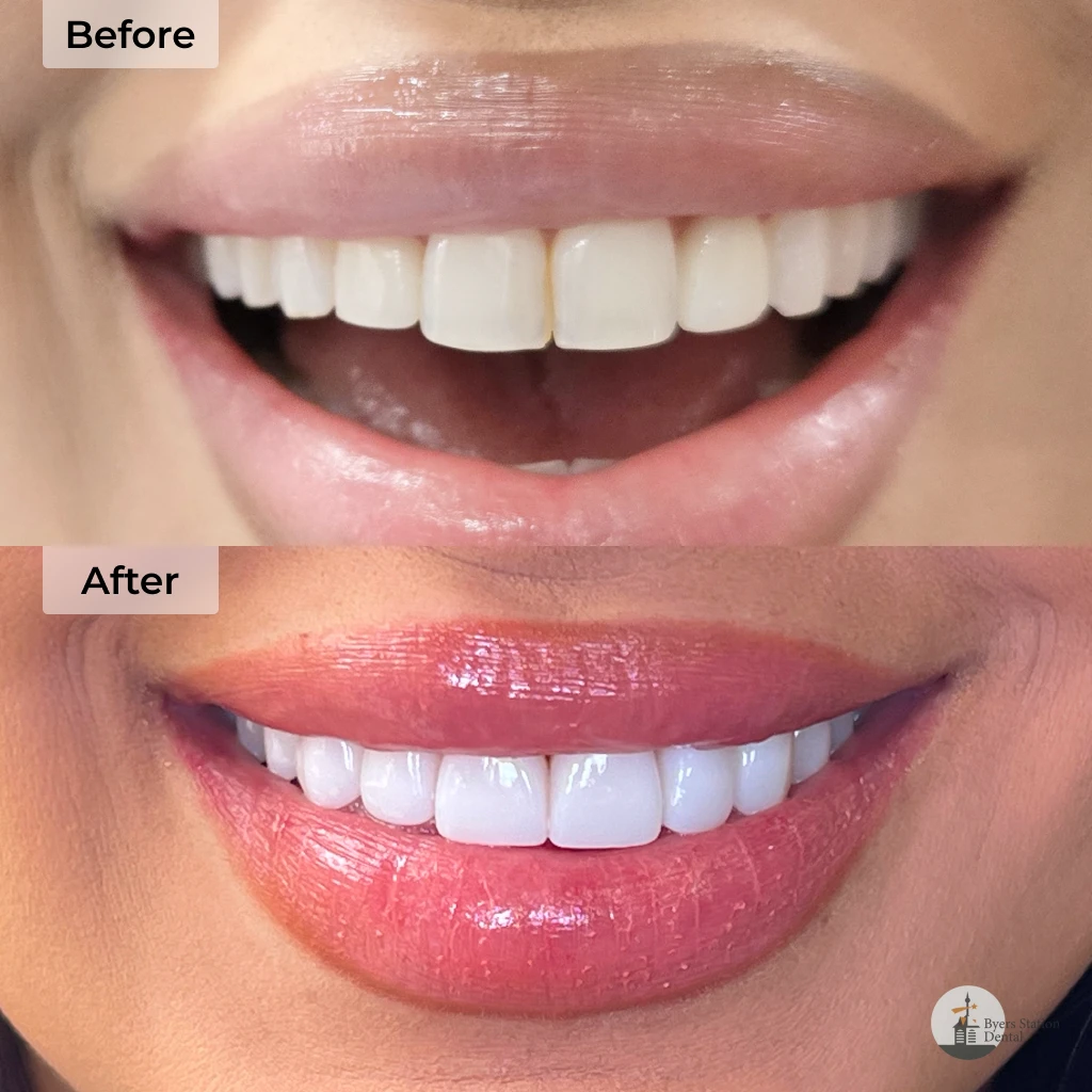 Veneers before and after in Chester Springs, PA