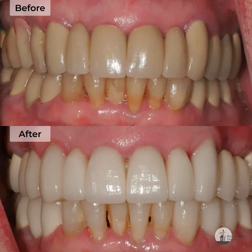 Dental implants before and after in Chester Springs, PA
