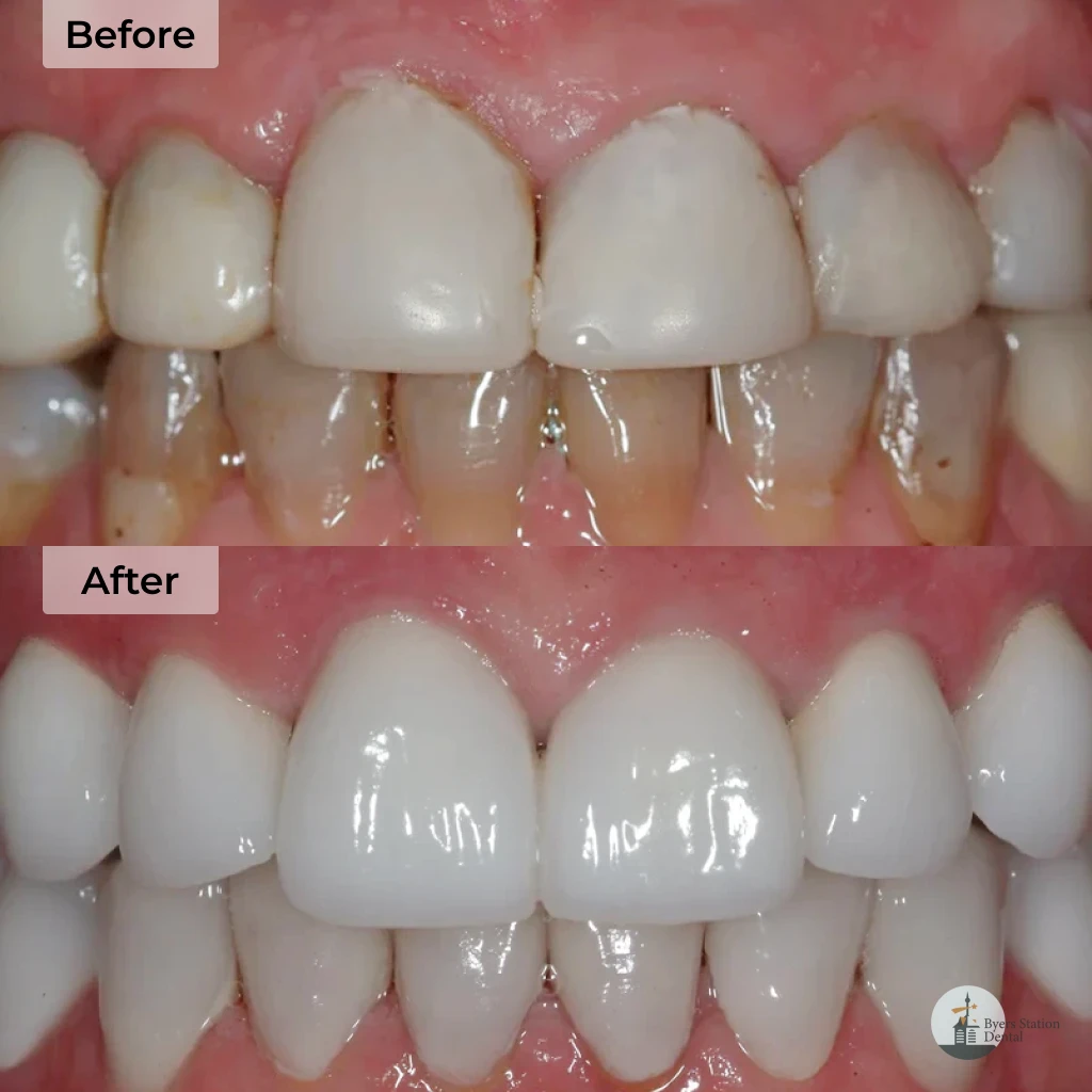 Smile design before and after in Chester Springs, PA