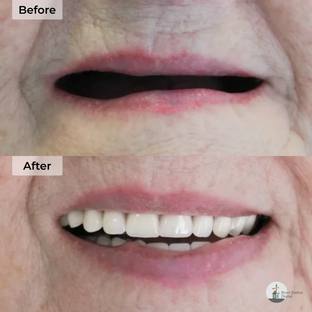 Snap-In Dentures before and after in Chester Springs, PA