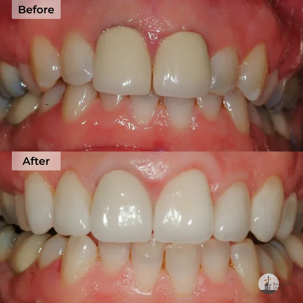 Smile makeover before and after in Chester Springs, PA