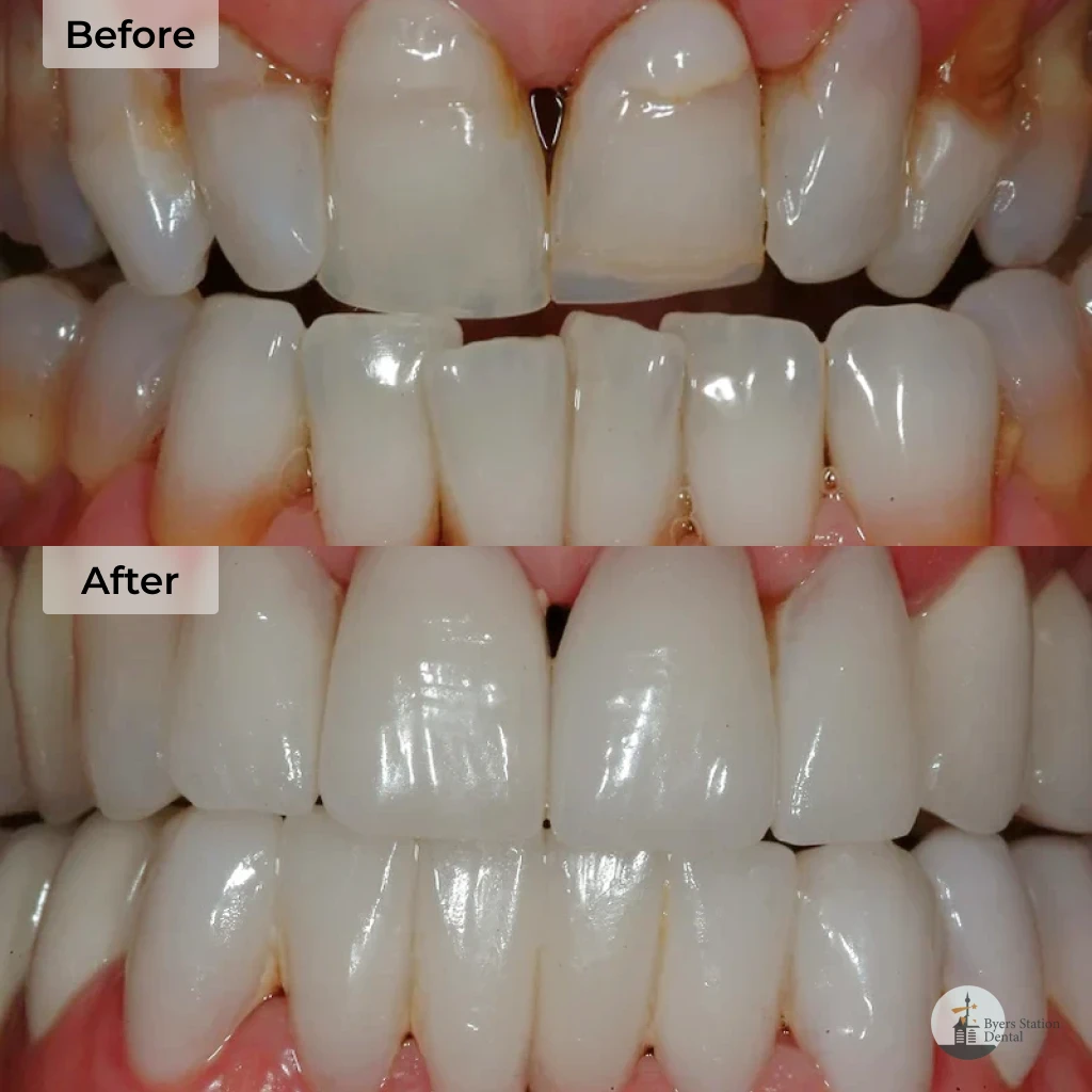Veneers before and after in Chester Springs, PA
