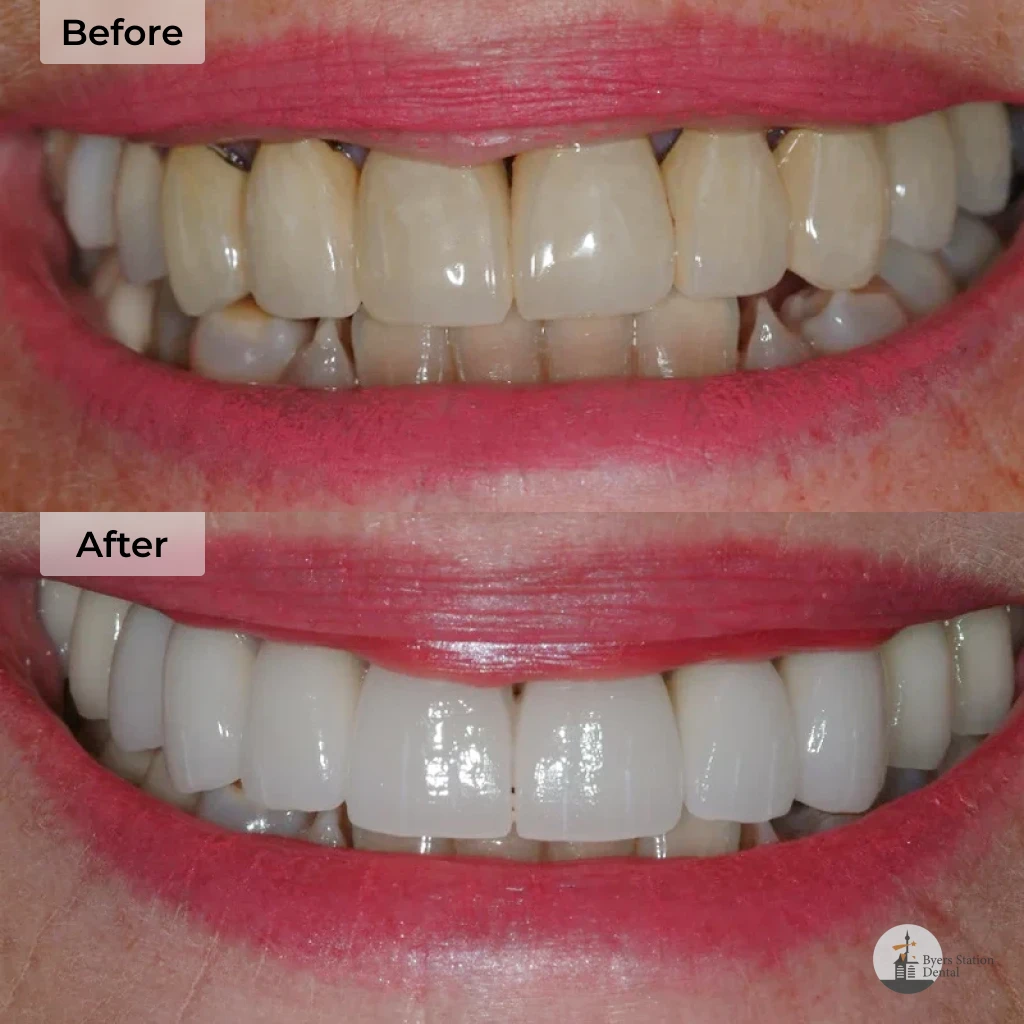 Dental implants before and after in Chester Springs, PA