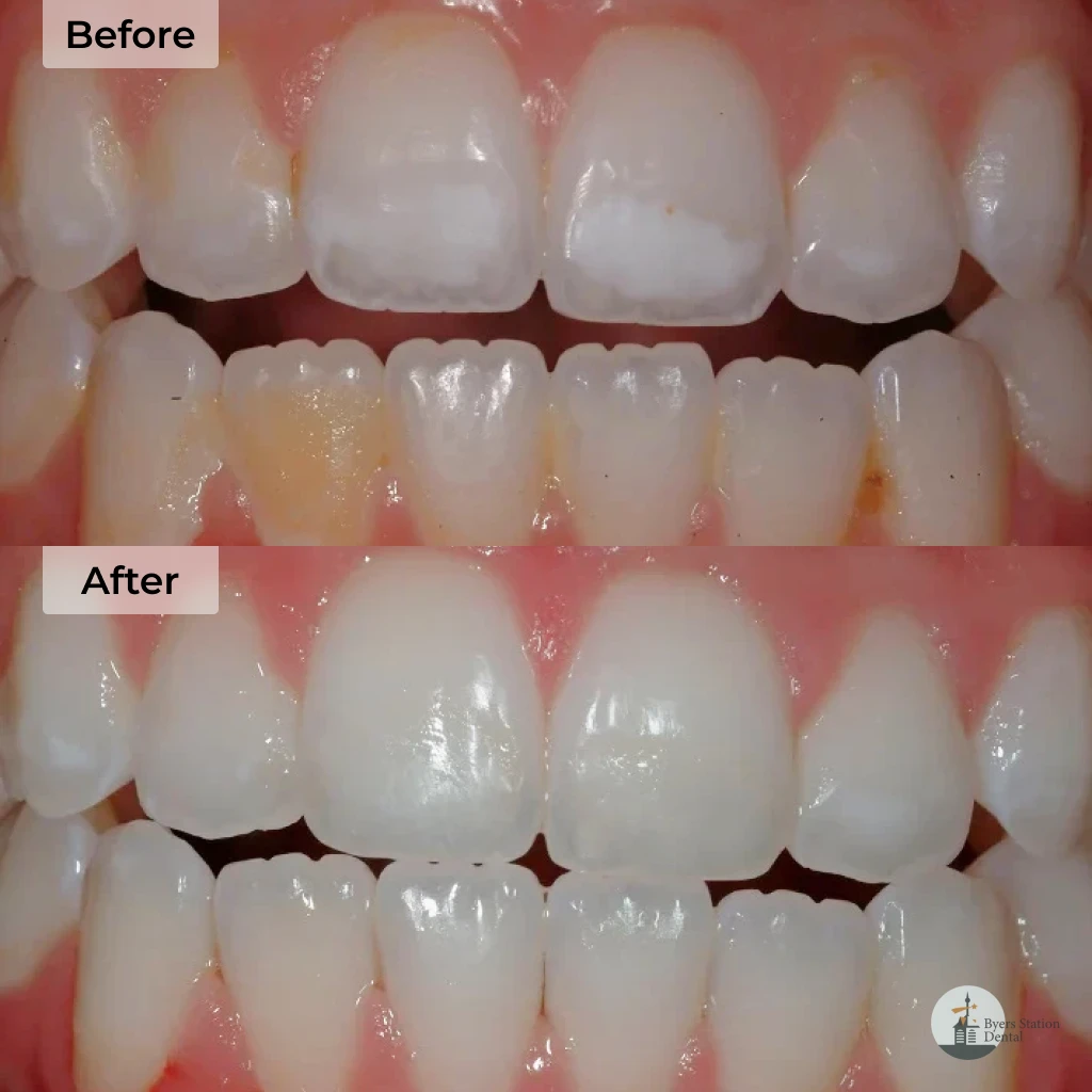 Teeth whitening before and after in Chester Springs, PA
