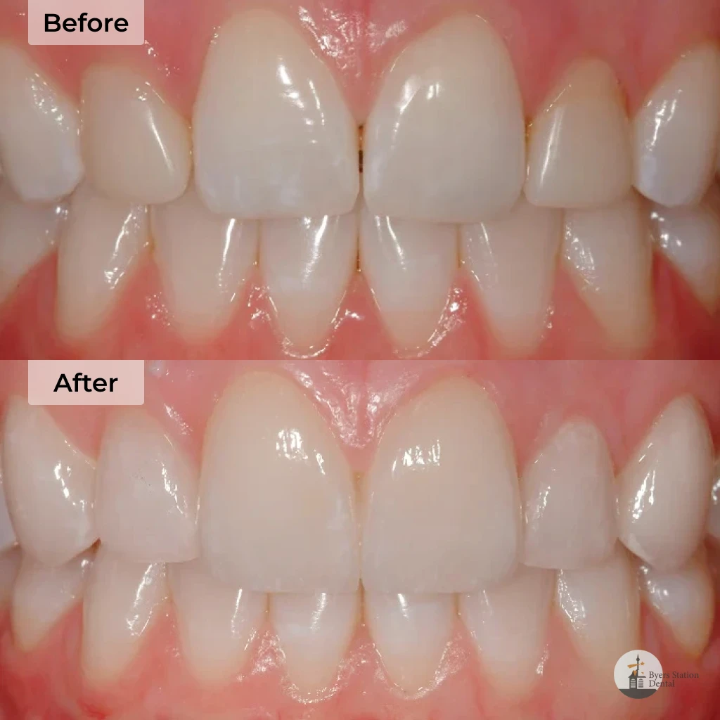 Veneers before and after in Chester Springs, PA