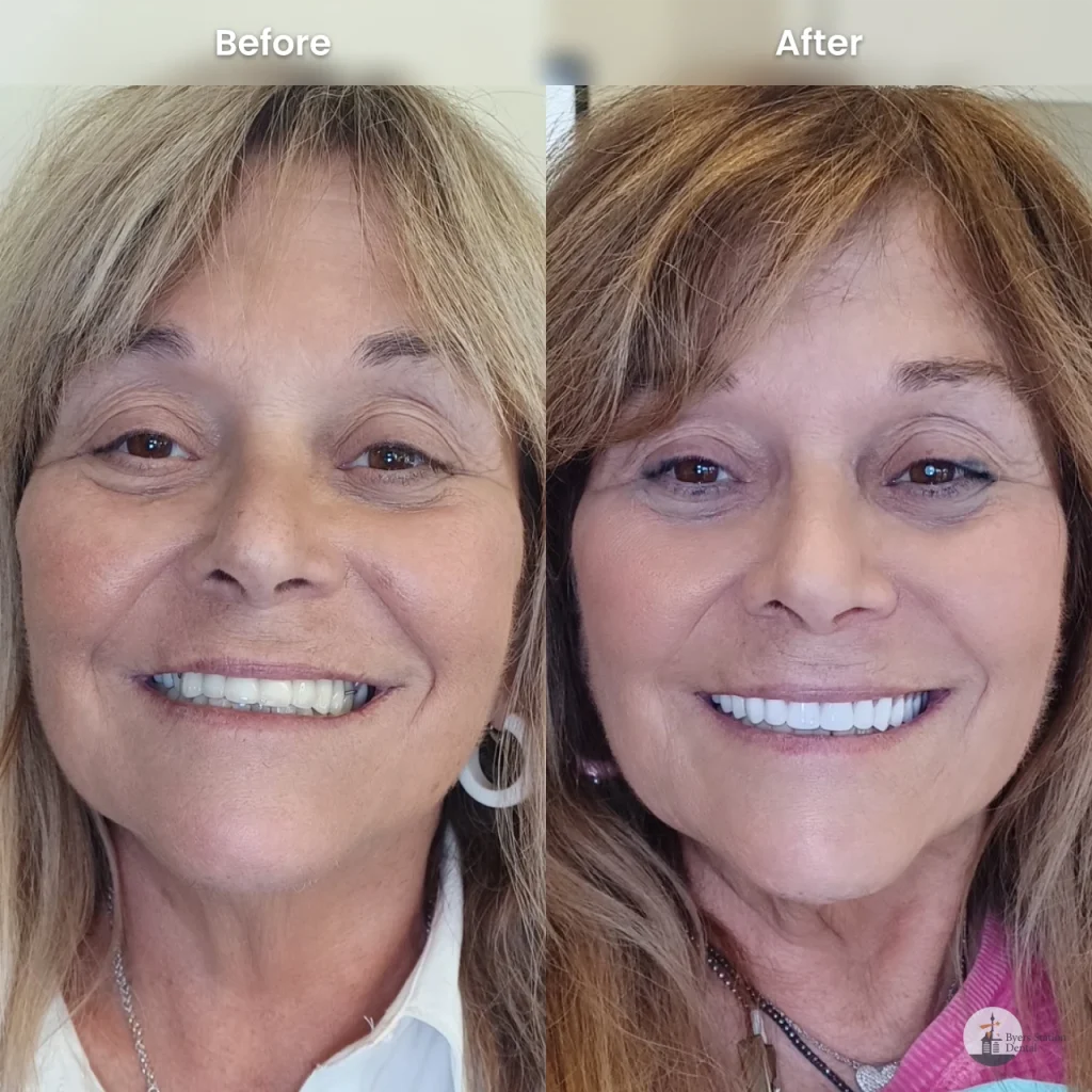 Eileen before and after a smile makeover